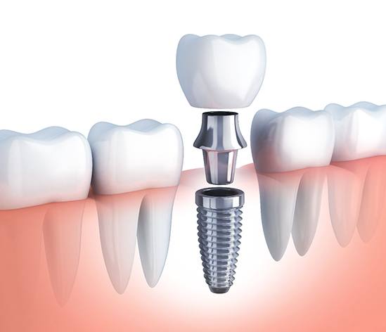 illustration of how dental implants work in Longmont