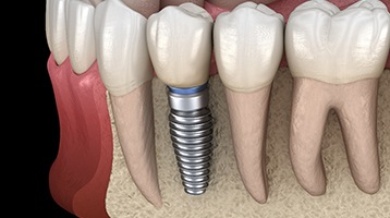 single dental implant in the jawbone 