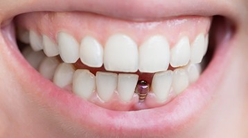 person smiling with a visible dental implant abutment