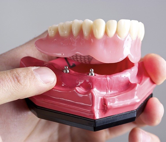 Model all on four dental implant supported denture