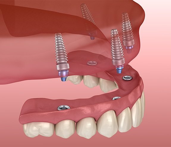 Animated dental implant supported all on four denture placement