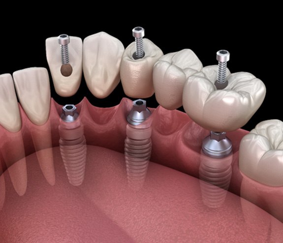 computer illustration of an implant bridge