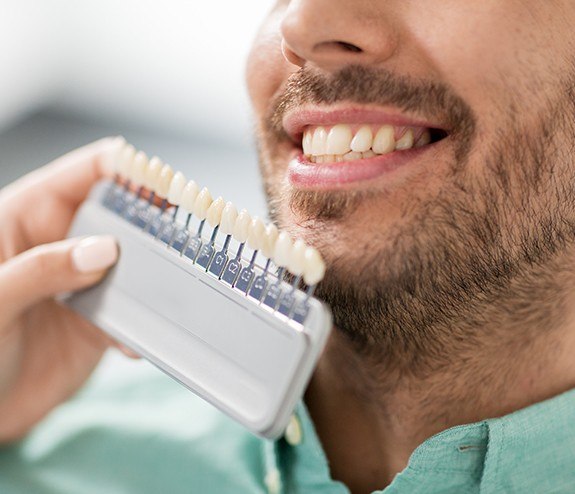 Man's smile compared with veneer shade chart