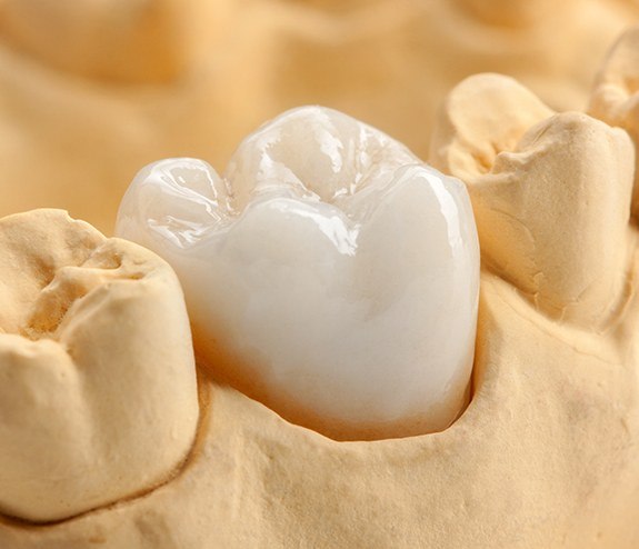 Model smile with dental crown restoration