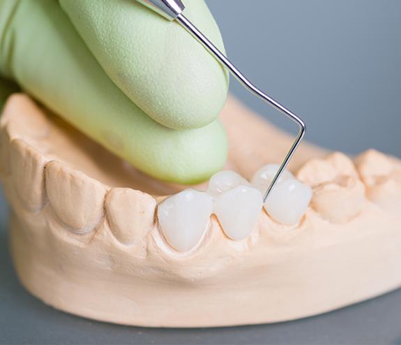 Model smile with fixed bridge restoration