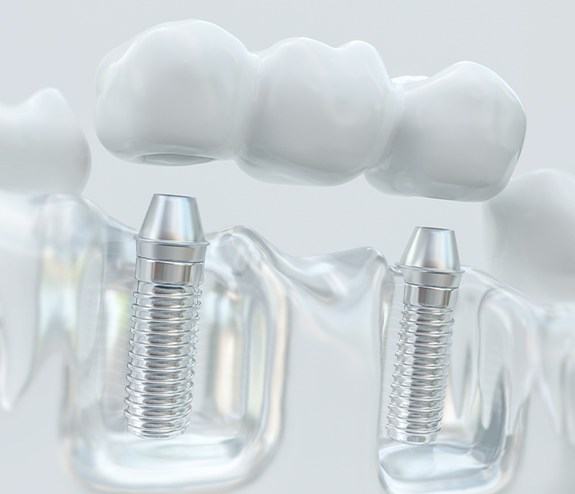 Model dental implant supported fixed bridge