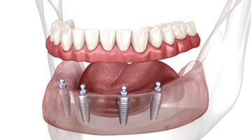 an illustration of implant dentures 