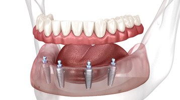 an illustration of implant dentures