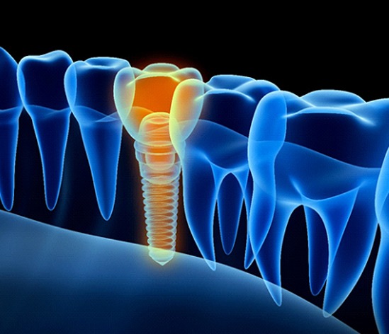 Diagram showing a failed dental implant in Longmont