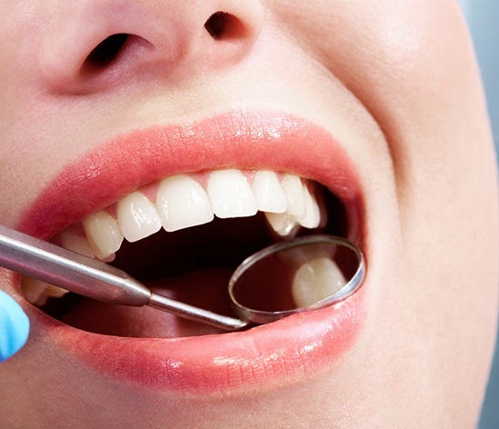 Closeup of dental mirror reflecting a woman’s tooth