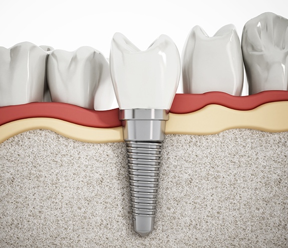Animated dental implant supported dental crown placement