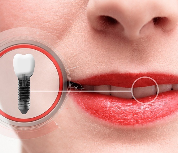 Patient's smile with an animated dental implant supported dental crown overlay