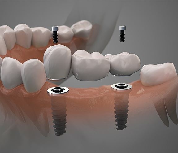 Animated dental implant supported fixed bridge restoration