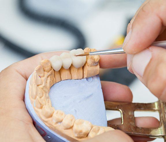 Model smile with dental implant supported fixed bridge