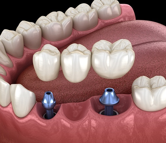 Animated dental implant supported fixed bridge placement
