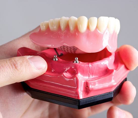 dentist holding model jaw with implant dentures in Longmont