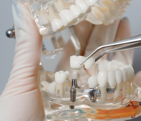 Model smile with dental implant supported fixed bridge placement