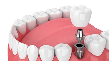 Diagram of a single tooth dental implant in Longmont