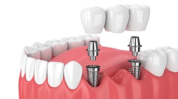 Diagram of an implant bridge replacing multiple missing teeth in Longmont