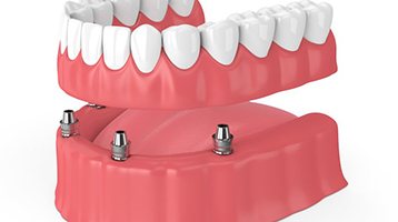 Diagram showing how implant dentures in Longmont work