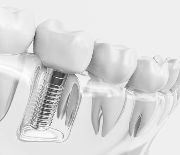 Diagram of a dental implant in Longmont inside a model