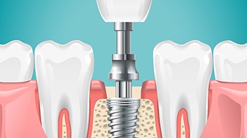 Dentist showing patient dental implant supported dental crown model