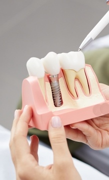 Dentist holding a model of a dental implant in the jaw