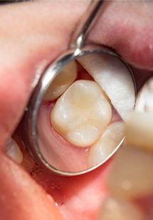 Closeup of dental mirror reflecting a tooth