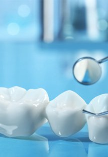 Dental implant and bridge on a reflective blue surface with dental mirror and tweezers