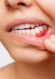 Nose-to-neck view of someone pulling down their lower lip to reveal red inflamed gums
