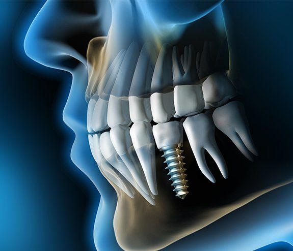 Animated dental implant supported dental crown