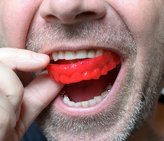 Closeup of man placing a mouthguard