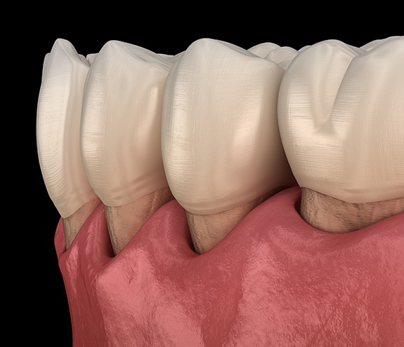 Animated smile with gum tissue recession