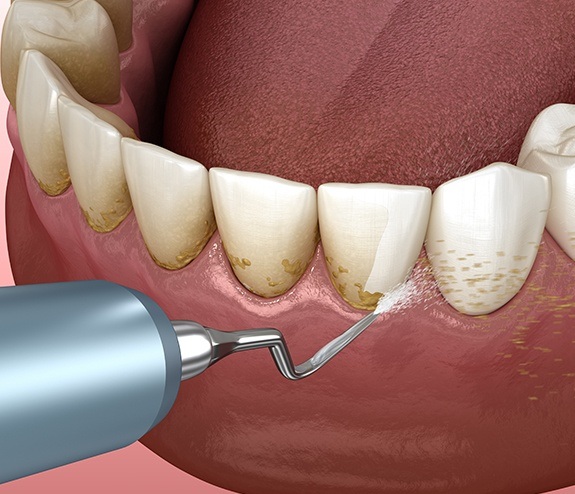 Patient receiving gum disease treatment