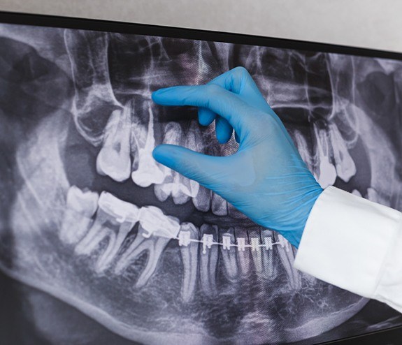 Dentist looking at dental x-rays of teeth after root canal therapy
