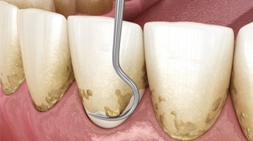 a 3D illustration of the scaling and root planing process