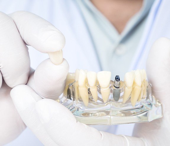 Dentist holding model smile with dental implant single tooth replacement