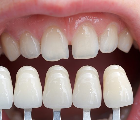 Closeup of smile during veneer treatment planning