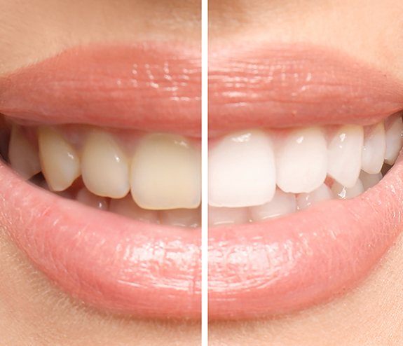 Smile before and after teeth whitening