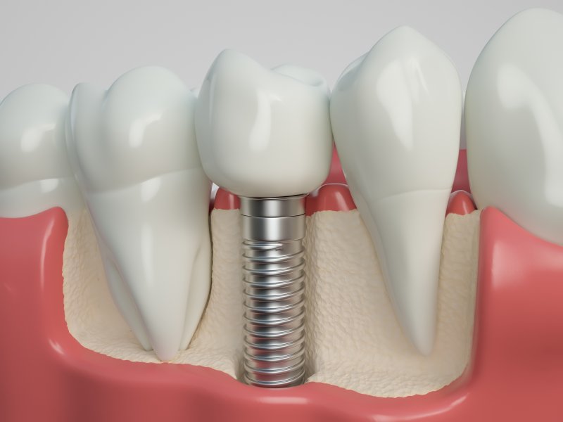 Dental Implant