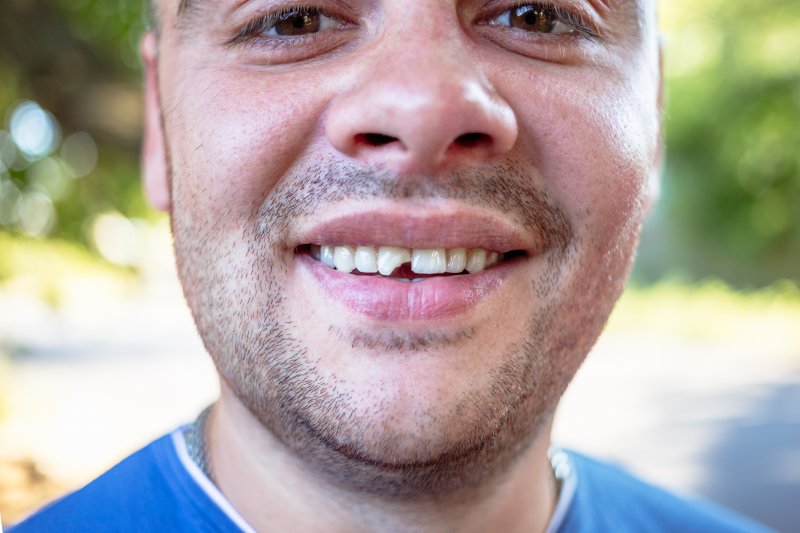 closeup of man with chipped tooth in Longmont
