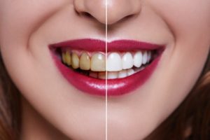 Closeup of yellow teeth in Longmont before and after teeth whitening 