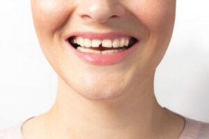 Person smiling with broken front tooth. 