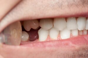 Close-up of smile with missing back tooth. 
