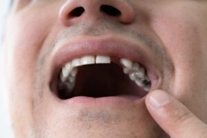Man smiles to reveal missing tooth. 