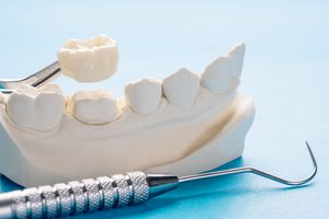 Dental crown held with dental instrument above model jaw